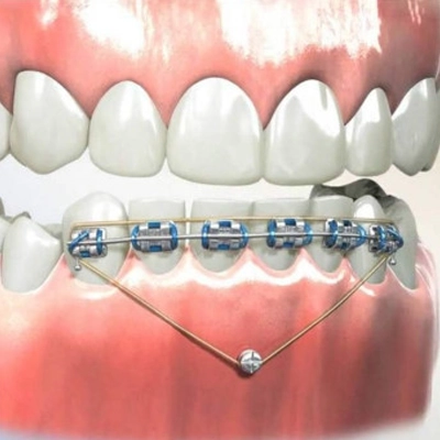 Getting Invisalign Invisalign in Midland