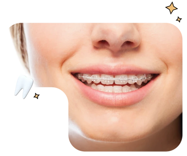 Ceramic Braces Clear Braces